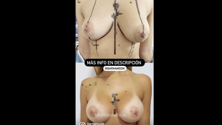 Mastopexia - Clínica BarnaMedik