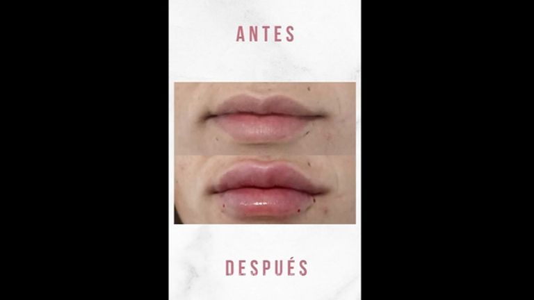 Aumento de labios - Clínicas CAME Murcia