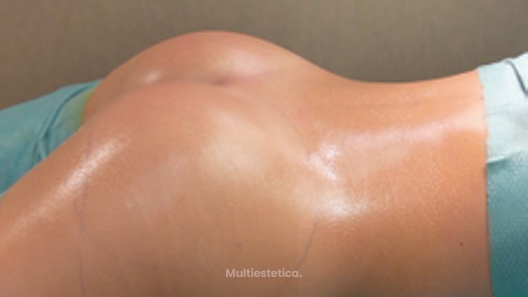 Aumento de glúteos con prótesis - Clínica Opción Médica