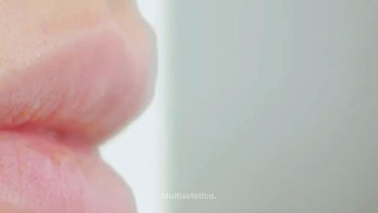 Colocación Labios - Clínica Montecarmelo