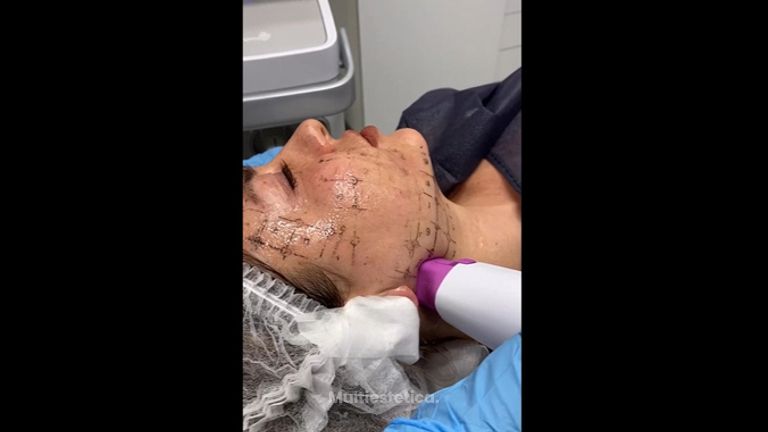 Radiofrecuencia facial - Dra. Denisa Bangean
