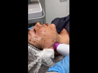 Radiofrecuencia facial - Dra. Denisa Bangean