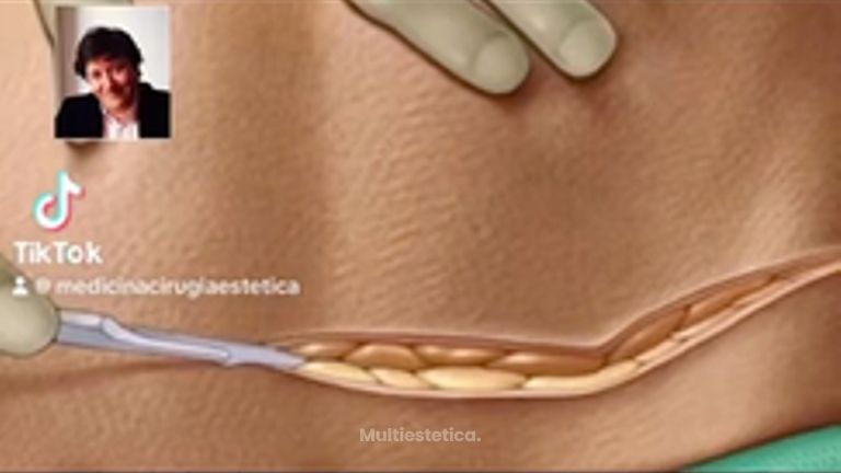 Abdominoplastia - Dr. Ruiz Montoya
