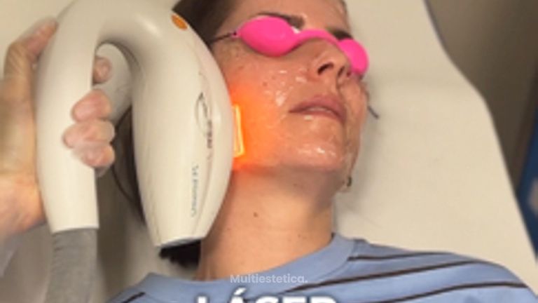 Láser IPL - Beatriz Bernal