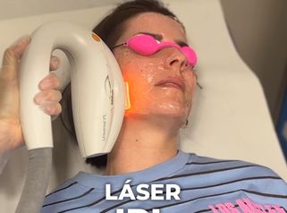 Láser IPL - Beatriz Bernal