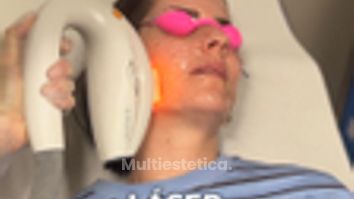 Láser IPL - Beatriz Bernal