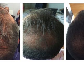 Tratamientos para eliminar la alopecia