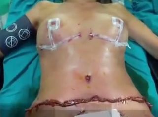 Planta cara al envejecimiento con la perfiloplastia corporal