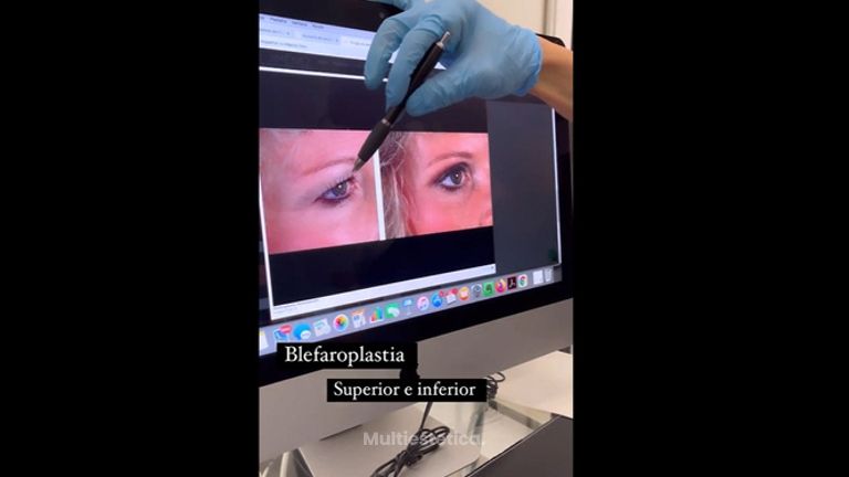 Blefaroplastia - Clínica Dr. Jiménez