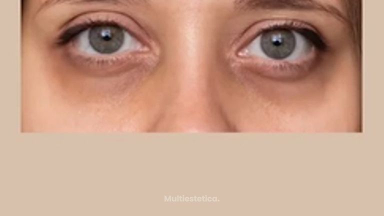 Dra. Andrea Tamargo - La zona del contorno de ojos es de las que más preocupaciones supone