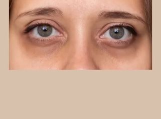 Dra. Andrea Tamargo - La zona del contorno de ojos es de las que más preocupaciones supone