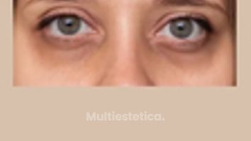 Dra. Andrea Tamargo - La zona del contorno de ojos es de las que más preocupaciones supone