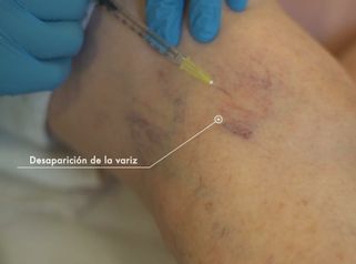 Clínica CIME - Tratamiento Escleroterapia Varices - Dr. Manuel Rubio
