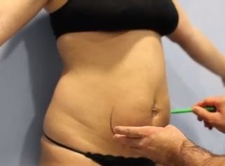 Aumento de glúteos brasileños Marbella Málaga Dr. Aslani