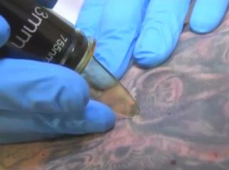 Cómo eliminar tatuajes