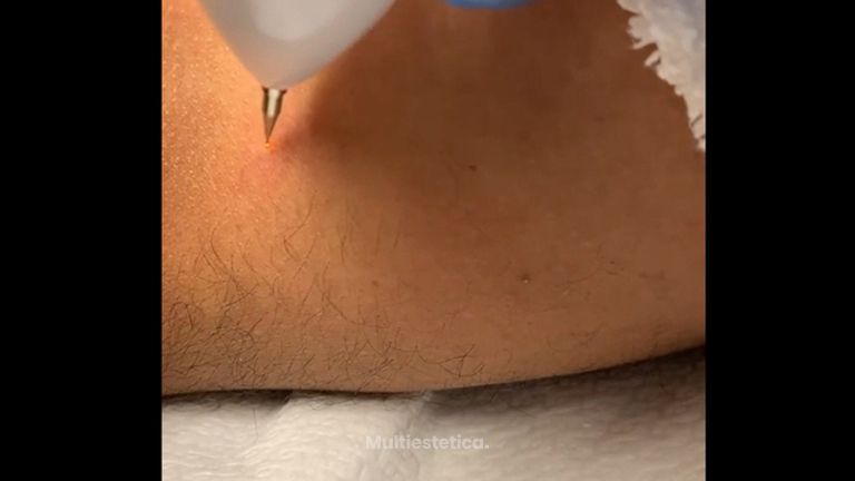 Eliminación de verrugas - D&S Clinic