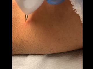 Eliminación de verrugas - D&S Clinic