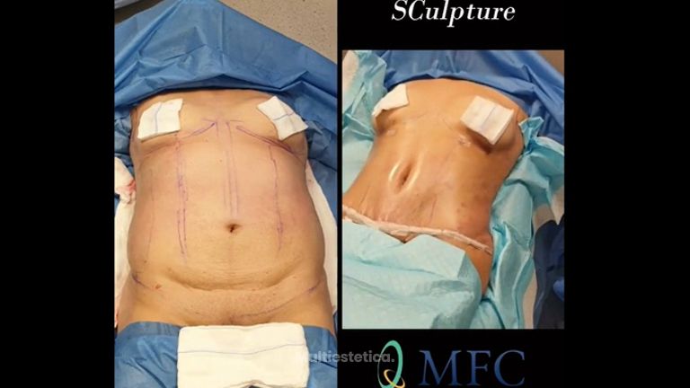 Abdominoplastia 