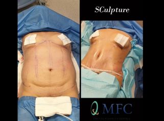 Abdominoplastia 