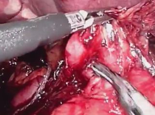 Elimina un cáncer gástrico