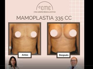 Mamoplastia 335cc