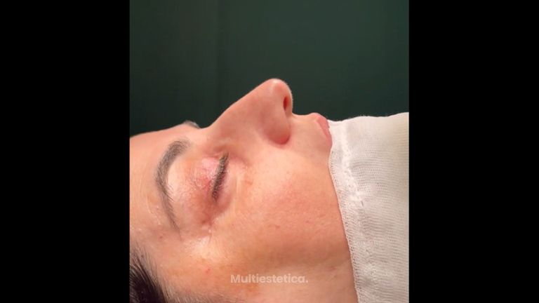 Rinoplastia - Dr. Pérez Villar