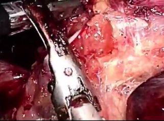 Así se hace una disección de tronco celiaco