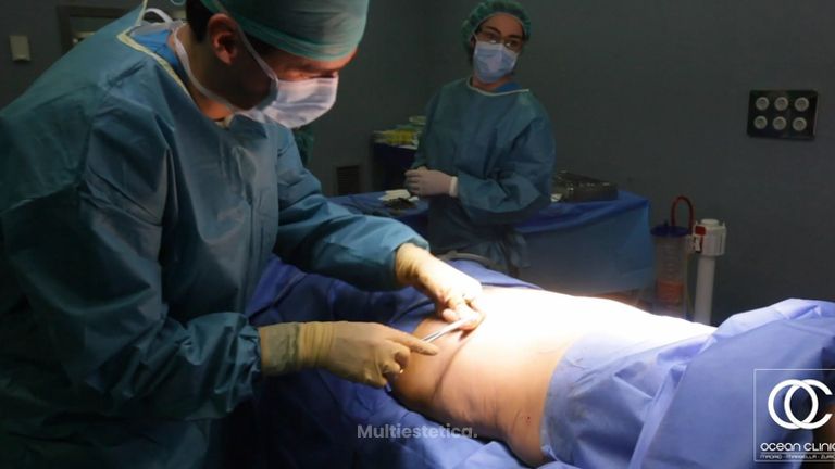 Liposucción 360º
