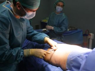 Liposucción 360º