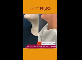Rejuvenecimiento de cuello - Clínica Rigo