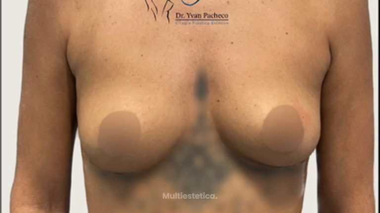 Aumento de pecho - Dr. Yvan Pacheco