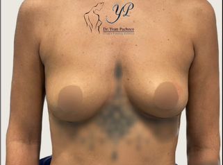 Aumento de pecho - Dr. Yvan Pacheco
