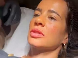 HIDRATACION DE LABIOS