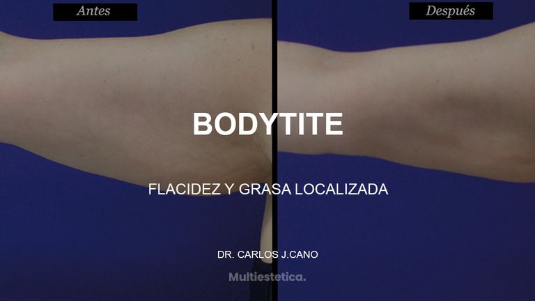 Bodytite - Clinica Tufet