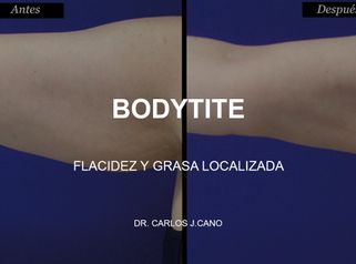 Bodytite - Clinica Tufet