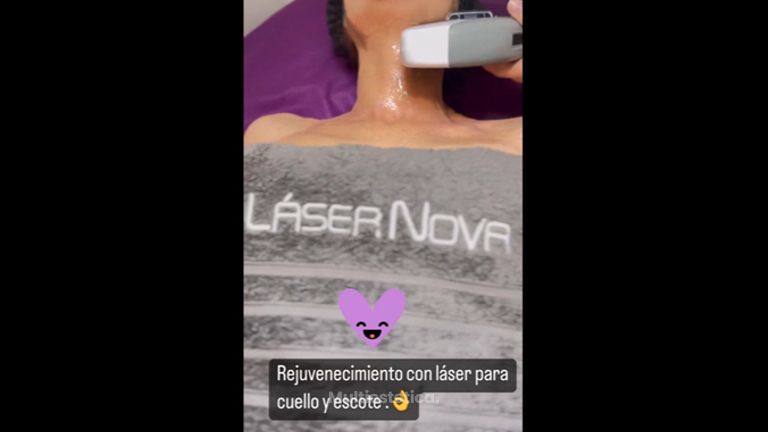 Rejuvenecimiento con láser - Clínica Lasernova