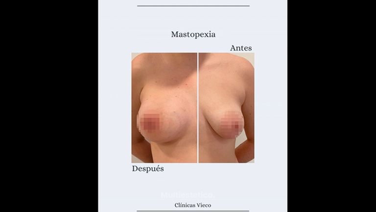 Mastopexia - Clínicas Vieco