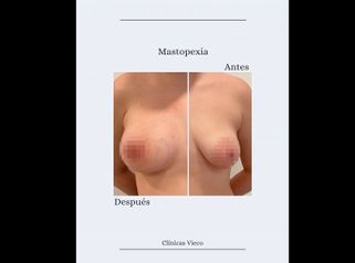 Mastopexia - Clínicas Vieco