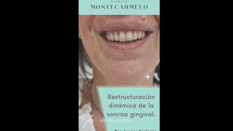Sonrisa gingival - Clínica Montecarmelo