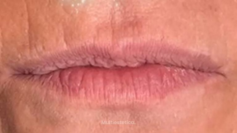 Hidratación y rectificación de labios