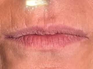 Hidratación y rectificación de labios