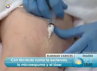 Con técnicas como la esclerosis conseguimos eliminar las varices.