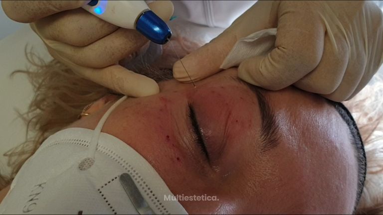 Blefaroplastia sin cirugía - Dra. Consol Montilla