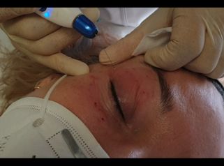 Blefaroplastia sin cirugía - Dra. Consol Montilla