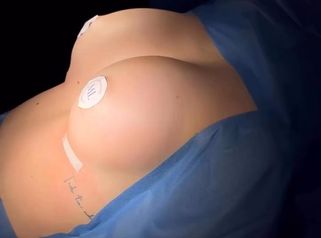 Aumento de pecho - Clínica Dr. Millán Longo y Asociados