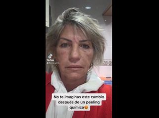 Peeling - Clínica IEMEC