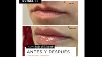 Aumento de labios