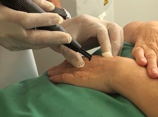 Rejuvenecimiento de manos - Policlínica Cume