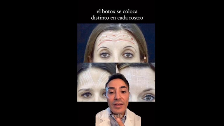 Rellenos faciales - Dr. Roberto Ramírez