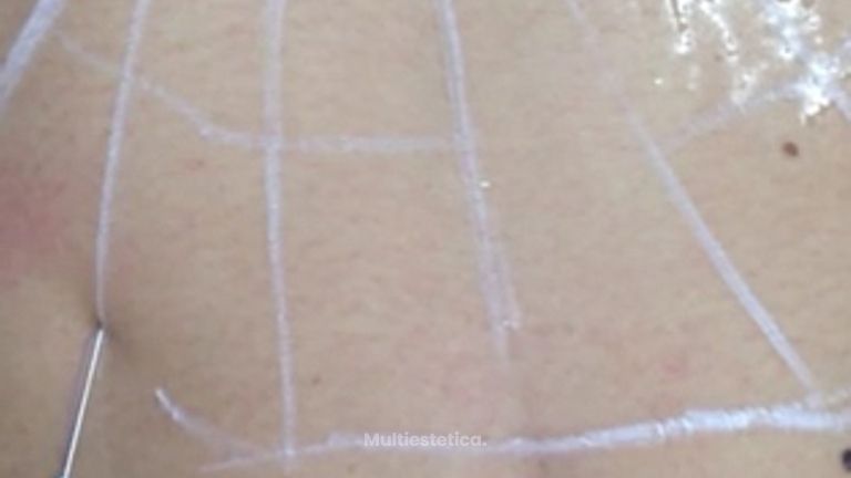 Hilos tensores en abdomen